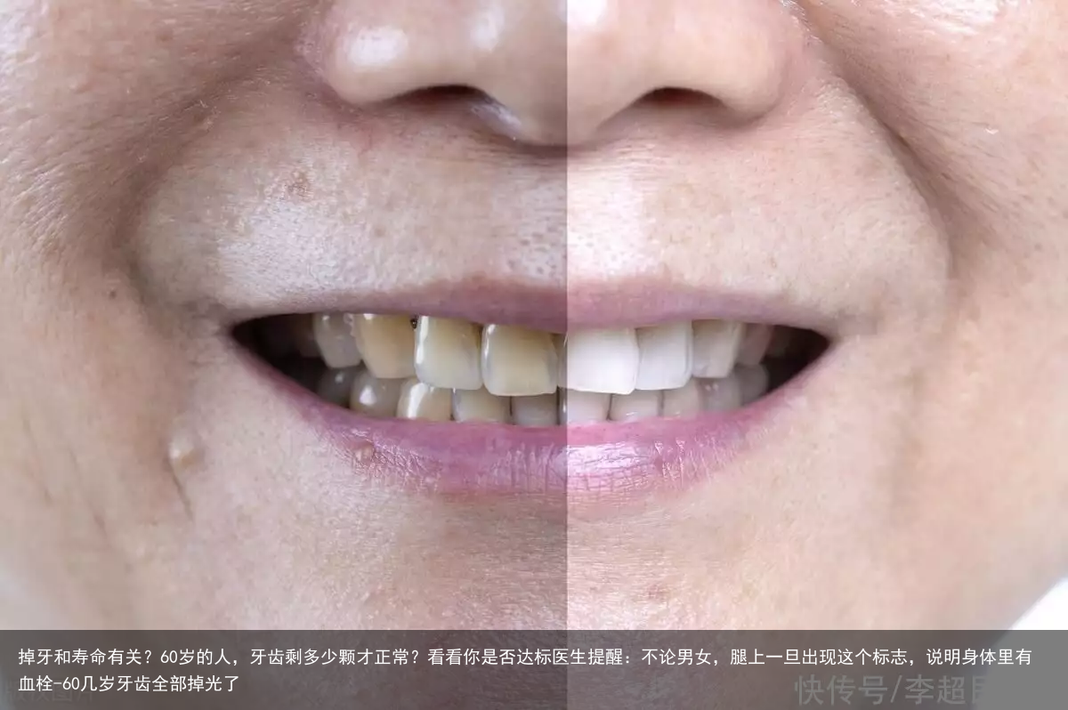 掉牙和寿命有关？60岁的人，牙齿剩多少颗才正常？看看你是否达标医生提醒：不论男女，腿上一旦出现这个标志，说明身体里有血栓-60几岁牙齿全部掉光了