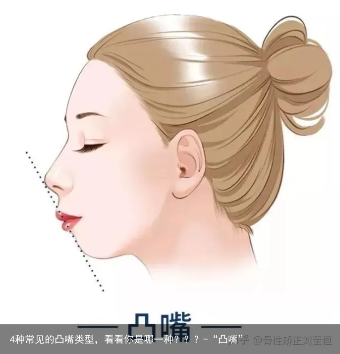 4种常见的凸嘴类型，看看你是哪一种？？？-“凸嘴”