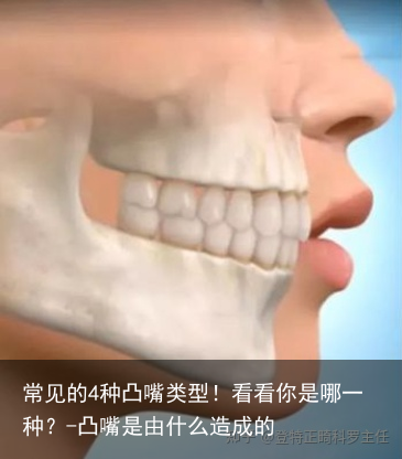 常见的4种凸嘴类型！看看你是哪一种？-凸嘴是由什么造成的