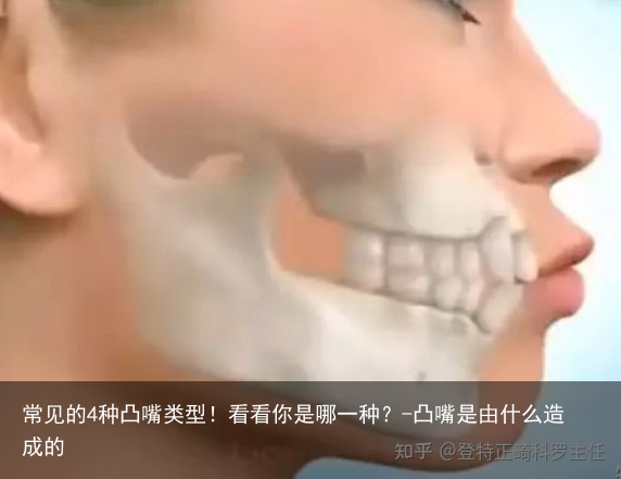 常见的4种凸嘴类型！看看你是哪一种？-凸嘴是由什么造成的