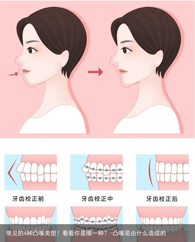 常见的4种凸嘴类型！看看你是哪一种？-凸嘴是由什么造成的