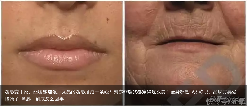 嘴唇变干瘪，凸嘴感增强，秀晶的嘴唇薄成一条线？刘亦菲遛狗都穿得这么美！全身都是LV太称职，品牌方要爱惨她了-嘴唇干到底怎么回事
