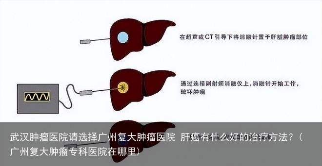 武汉肿瘤医院请选择广州复大肿瘤医院 肝癌有什么好的治疗方法？(广州复大肿瘤专科医院在哪里)