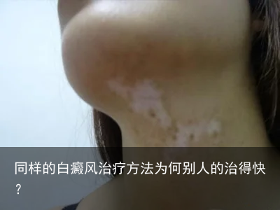 同样的白癜风治疗方法为何别人的治得快？