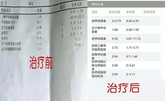 甲状腺疾病最爱盯上这4类人！中医“一疏一补”，消结节、治甲亢，内外同治防复发~