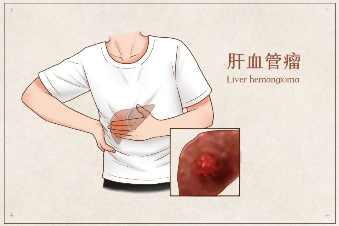 体检发现肝脏小结节，担心会癌变？有这样的表现要警惕！