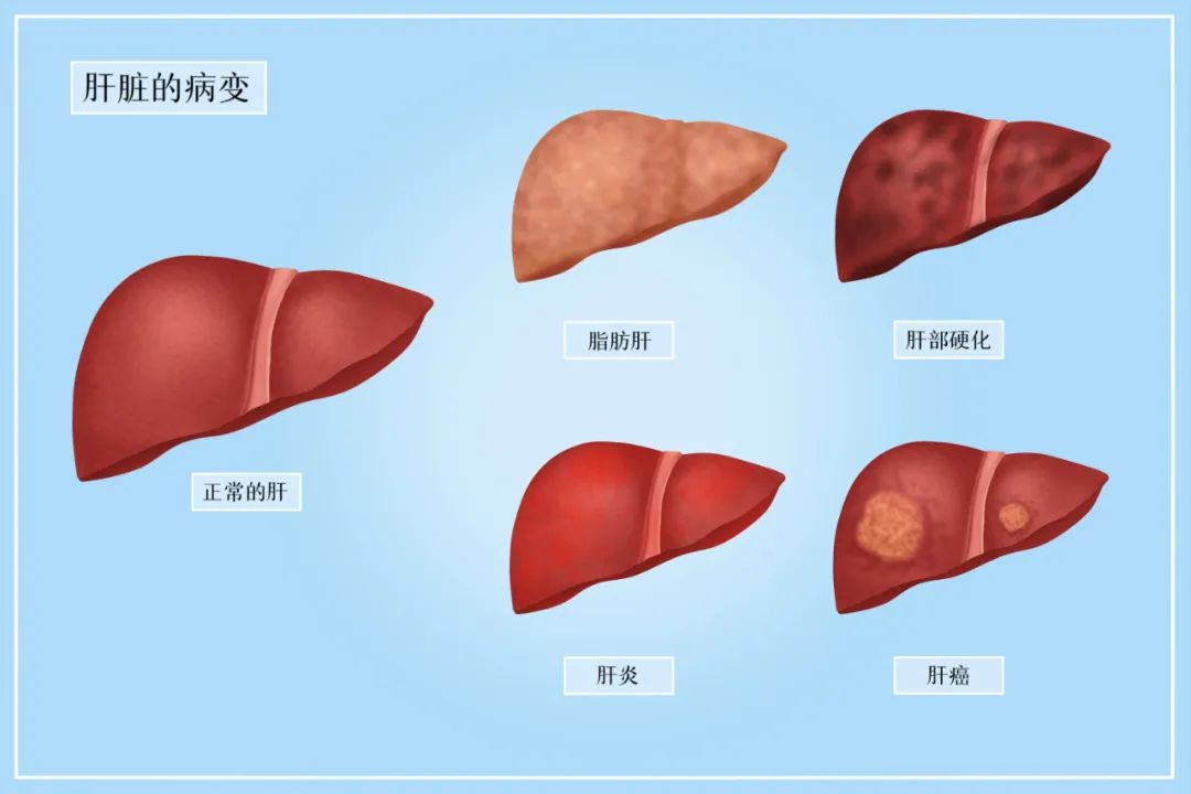 体检发现肝脏小结节，担心会癌变？有这样的表现要警惕！