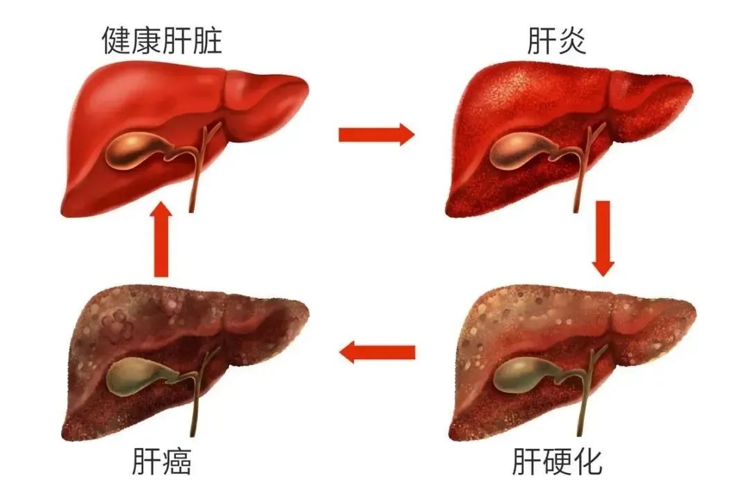 中医治疗结节更有优势，别让肝结节成为你的“劫”！