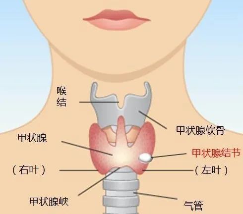 结节到底是什么？艾灸怎么消除？