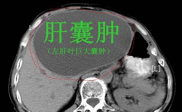 肝脏结节是恶性的吗？是不是要手术切除？看完此文你自己都会治了