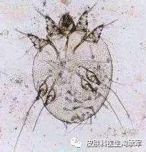 你知道疥疮是什么吗？-疥疮是什么引起的,什么症状