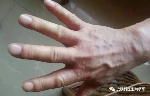 你知道疥疮是什么吗？-疥疮是什么引起的,什么症状