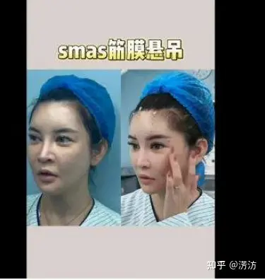 筋膜提升术是什么？闺蜜问：筋膜提升多少钱？-目前最安全的面部提升手术