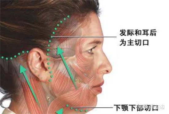 筋膜提升术是什么、筋膜提升拉皮手术维持多久-筋膜提拉手法