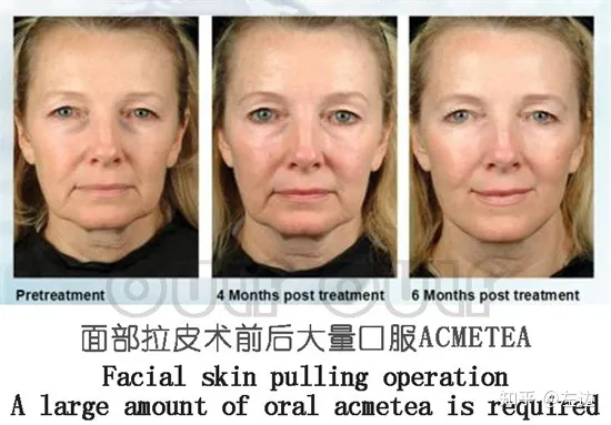 筋膜提升术是什么、筋膜提升拉皮手术维持多久-筋膜提拉手法