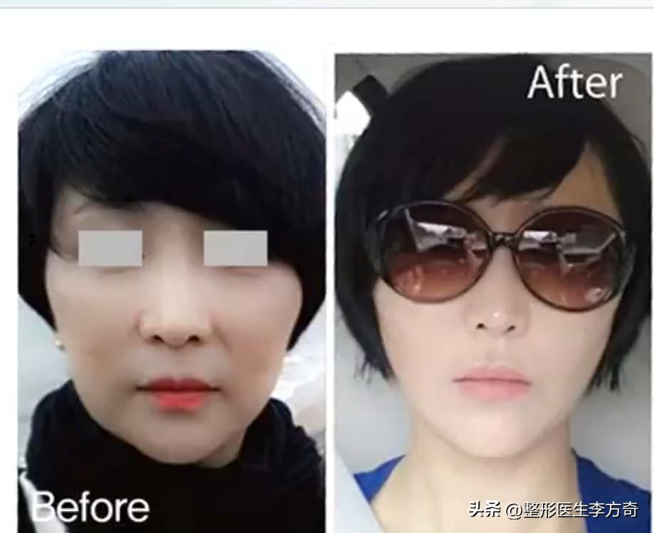 花1万多做线雕被坑又做了提拉带提升才明白什么叫真正的筋膜悬吊-做线雕提拉紧致要多少钱?