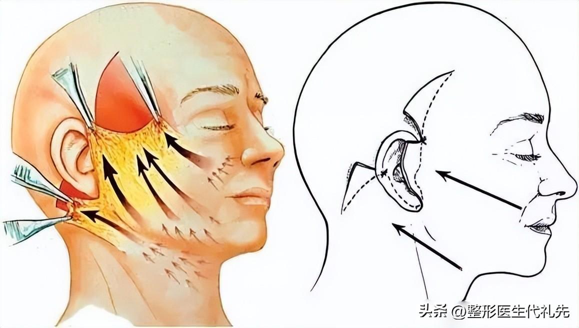 总结了最近准备做拉皮手术的求美者咨询的最多的8个问题-拉皮手术费用是多少