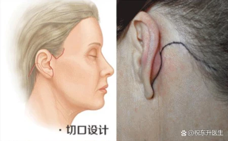 拉皮术后37天、70天，模样大不一样，从面诊到手术过程分享-拉皮术后的效果是最终效果吗
