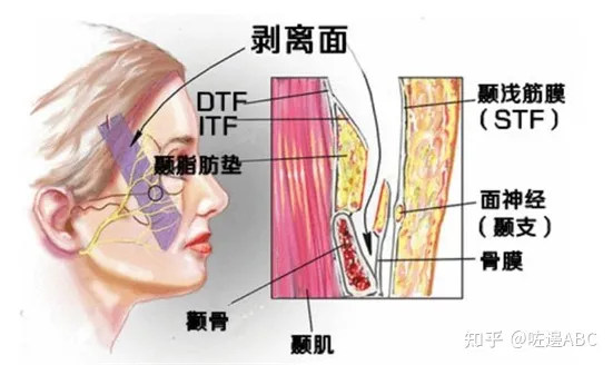 面部筋膜提升术的危害、中面部提升术的后遗症大吗，细品-筋膜提拉术手术全过程
