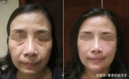 抗衰干货，如何改善面部下垂？-如何抵抗面部下垂