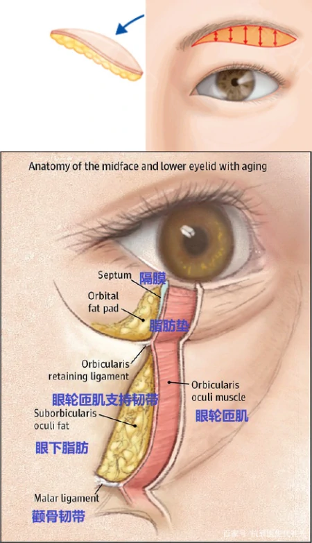 关于提眉去眼袋的大实话，医生来说几点真相，避免踩坑-提眉去眼袋注意事项