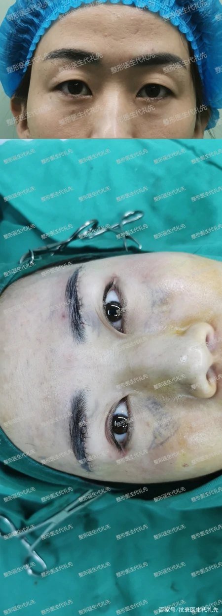 关于提眉去眼袋的大实话，医生来说几点真相，避免踩坑-提眉去眼袋注意事项