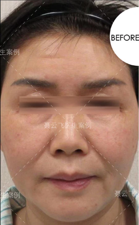 55岁做线雕没效果，来广州做拉皮手术，1周后像变了个人-线雕拉皮视频全过程播放