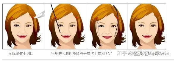 面部提升价格大概是多少？-面部提升怎么样
