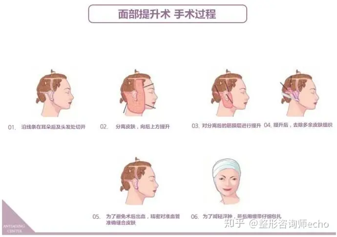 面部提升价格大概是多少？-面部提升怎么样
