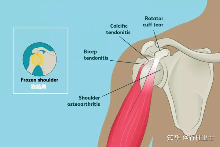 年龄大了得了肩周炎，做哪些运动能改善？（老年肩周炎怎么锻炼好）