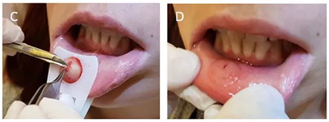 口腔溃疡怎么样才能好的更快？-口腔溃疡怎么能尽快好