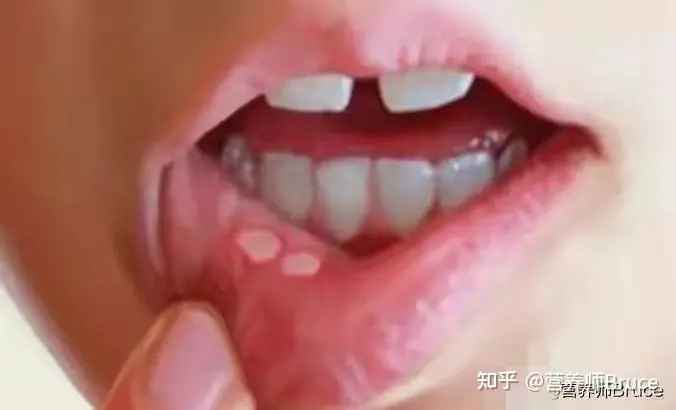 口腔溃疡有什么快速疗法？-口腔溃疡怎冶疗最好