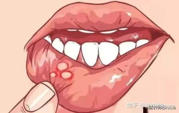 口腔溃疡有什么快速疗法？-口腔溃疡怎冶疗最好