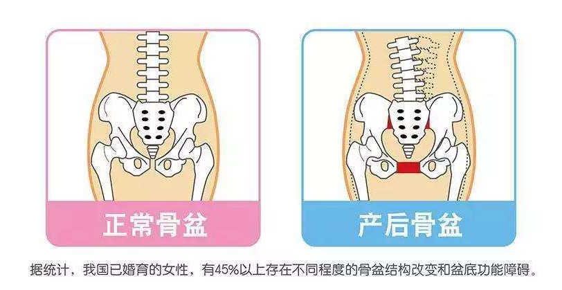 女性朋友生完宝宝后，到底要不要做产后修复-女性朋友生孩子