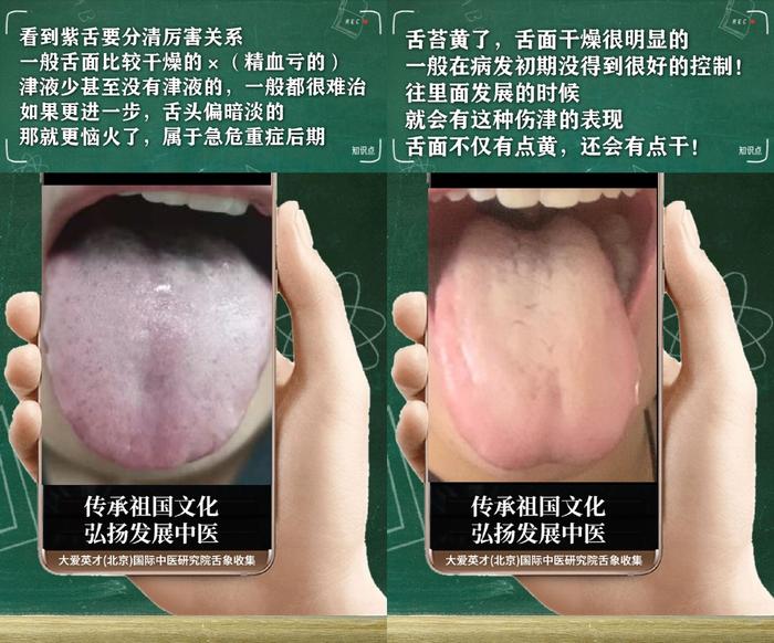 舌诊分析：生气、睡眠紊乱、水湿上泛、忽好忽坏很受影响-生气用中医学怎么说