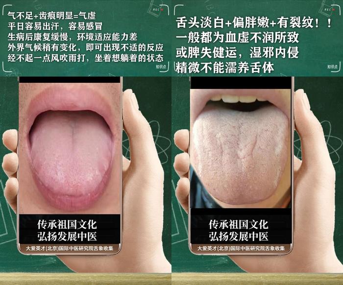 舌诊分析：生气、睡眠紊乱、水湿上泛、忽好忽坏很受影响-生气用中医学怎么说