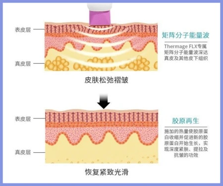 光子嫩肤能和水光针、瘦脸针一起做吗？会不会对皮肤不好？（先打水光针还是先做光子嫩肤）