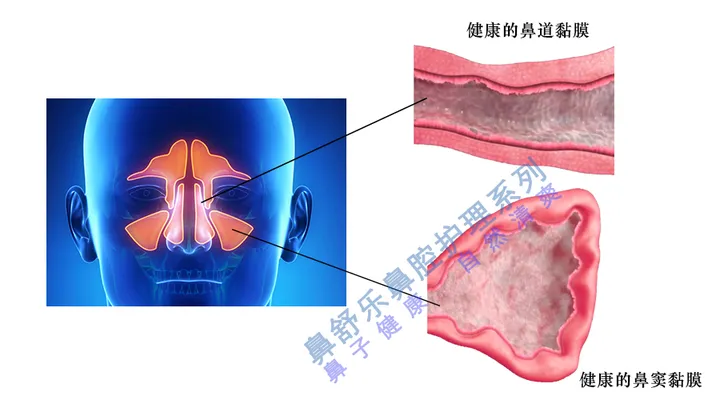 鼻窦炎如何根治？（儿童鼻窦炎的最明显五大症状）