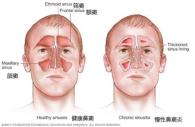鼻塞你以为是鼻炎了？其实还有可能是鼻窦炎，4招改善鼻窦炎烦恼（鼻塞是鼻窦炎的症状吗）