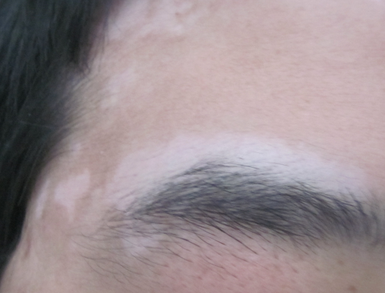 该如何治疗男性的白癜风（男性怎么治）