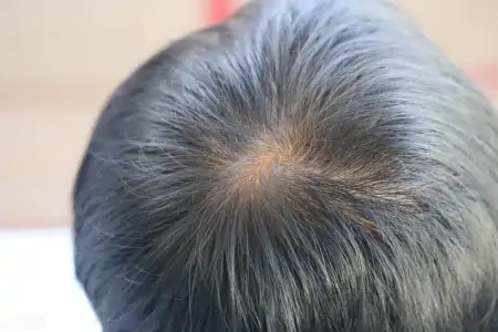 非那雄胺喷雾剂，已完成全球首例应用，男性雄激素脱发治疗新希望（非那雄胺喷涂治疗脱发用法）
