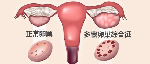 多囊卵巢综合征怎样治疗好的快-多囊卵巢综合症治疗方法