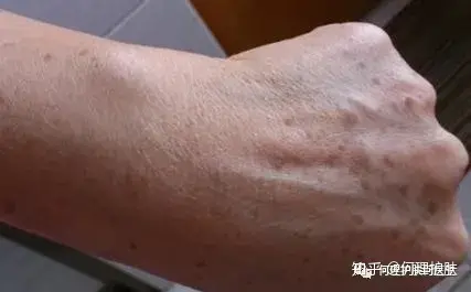 可见一“斑”，色斑及色沉的预防及治疗！-可见一斑为什么是斑点的斑?