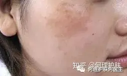 可见一“斑”，色斑及色沉的预防及治疗！-可见一斑为什么是斑点的斑?