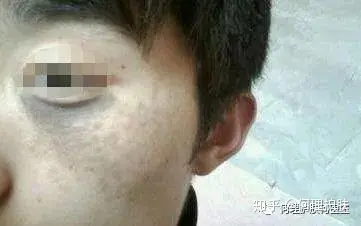 可见一“斑”，色斑及色沉的预防及治疗！-可见一斑为什么是斑点的斑?