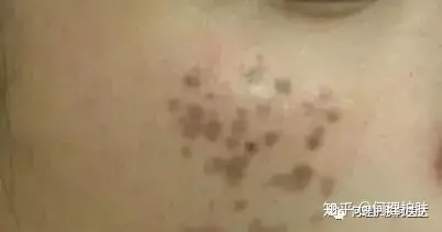 可见一“斑”，色斑及色沉的预防及治疗！-可见一斑为什么是斑点的斑?