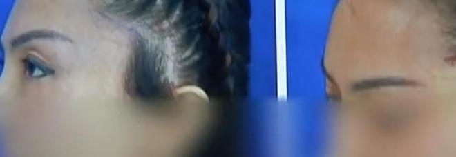 花15500做面部提拉，女子术后只能戴口罩示人，医师回应令人愤恨-面部提升带