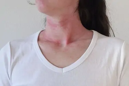 以前不过敏，为何突然开始过敏了？过敏不遗传，遗传的是它-以前不过敏,现在变过敏体质
