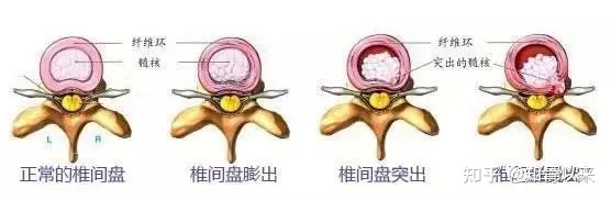 腰椎间盘突出症的治疗方法（完整版）-腰椎间盘突出症的治疗方式