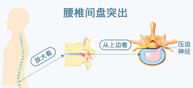 体医科普｜腰椎间盘比业绩更突出？五种锻炼方法有助缓解-腰椎间盘突出该怎么锻炼效果较佳